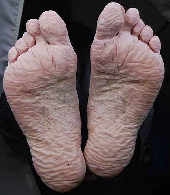 The soles of two feet showing the beginnings of trench foot
