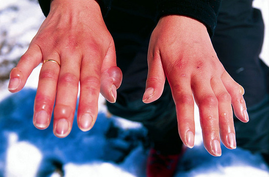 Frostbitten hands